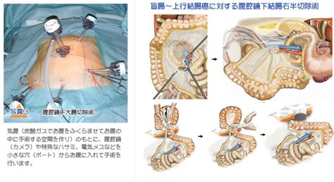 S字結腸法